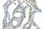 The image on the left is immunohistochemistry of paraffin-embedded Human thyroid cancer tissue using CSB-PA981013(ENTPD1 Antibody) at dilution 1/25, on the right is treated with synthetic peptide. (Original magnification: 