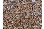 The image on the left is immunohistochemistry of paraffin-embedded Human thyroid cancer tissue using CSB-PA981190(DCAF6 Antibody) at dilution 1/30, on the right is treated with synthetic peptide. (Original magnification: 