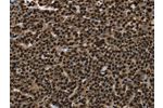 The image on the left is immunohistochemistry of paraffin-embedded Human ovarian cancer tissue using CSB-PA981207(ANP32E Antibody) at dilution 1/25, on the right is treated with synthetic peptide. (Original magnification: 