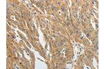 The image on the left is immunohistochemistry of paraffin-embedded Human ovarian cancer tissue using CSB-PA981490(F3 Antibody) at dilution 1/20, on the right is treated with fusion protein. (Original magnification: 