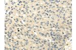 The image on the left is immunohistochemistry of paraffin-embedded Human breast cancer tissue using CSB-PA981570(GAD1 Antibody) at dilution 1/20, on the right is treated with synthetic peptide. (Original magnification: 