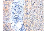The image on the left is immunohistochemistry of paraffin-embedded Human cervical cancer tissue using CSB-PA981926(ANK3 Antibody) at dilution 1/50, on the right is treated with synthetic peptide. (Original magnification: 