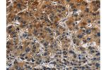 The image on the left is immunohistochemistry of paraffin-embedded Human liver cancer tissue using CSB-PA982170(CLDN8 Antibody) at dilution 1/50, on the right is treated with synthetic peptide. (Original magnification: 