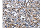 The image on the left is immunohistochemistry of paraffin-embedded Human thyroid cancer tissue using CSB-PA982897(CD177 Antibody) at dilution 1/30, on the right is treated with fusion protein. (Original magnification: 