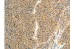 The image on the left is immunohistochemistry of paraffin-embedded Human liver cancer tissue using CSB-PA983024(FAT3 Antibody) at dilution 1/20, on the right is treated with synthetic peptide. (Original magnification: 