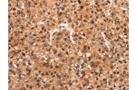 The image on the left is immunohistochemistry of paraffin-embedded Human liver cancer tissue using CSB-PA983101(FOXN2 Antibody) at dilution 1/15, on the right is treated with synthetic peptide. (Original magnification: 