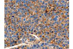 The image on the left is immunohistochemistry of paraffin-embedded Human esophagus cancer tissue using CSB-PA983237(CLDN1 Antibody) at dilution 1/150, on the right is treated with synthetic peptide. (Original magnification: 