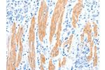 The image on the left is immunohistochemistry of paraffin-embedded Human gastic cancer tissue using CSB-PA983294(AKT3 Antibody) at dilution 1/30, on the right is treated with synthetic peptide. (Original magnification: 