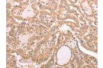 The image on the left is immunohistochemistry of paraffin-embedded Human thyroid cancer tissue using CSB-PA983505(AASDHPPT Antibody) at dilution 1/30, on the right is treated with fusion protein. (Original magnification: 