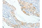 The image on the left is immunohistochemistry of paraffin-embedded Human cervical cancer tissue using CSB-PA983797(APOL2 Antibody) at dilution 1/80, on the right is treated with synthetic peptide. (Original magnification: 