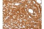 The image on the left is immunohistochemistry of paraffin-embedded Human thyroid cancer tissue using CSB-PA984347(CNN3 Antibody) at dilution 1/25, on the right is treated with fusion protein. (Original magnification: 