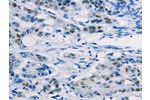 The image on the left is immunohistochemistry of paraffin-embedded Human colon cancer tissue using CSB-PA984353(ABCC1 Antibody) at dilution 1/20, on the right is treated with synthetic peptide. (Original magnification: 
