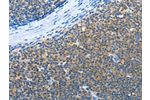 The image on the left is immunohistochemistry of paraffin-embedded Human lymphoma cancer tissue using CSB-PA984808(AMDHD2 Antibody) at dilution 1/30, on the right is treated with fusion protein. (Original magnification: 