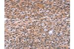 The image on the left is immunohistochemistry of paraffin-embedded Human ovarian cancer tissue using CSB-PA985124(BAP1 Antibody) at dilution 1/40, on the right is treated with fusion protein. (Original magnification: 