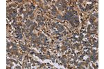 The image on the left is immunohistochemistry of paraffin-embedded Human liver cancer tissue using CSB-PA985162(FLNA Antibody) at dilution 1/40, on the right is treated with fusion protein. (Original magnification: 
