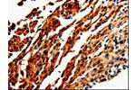The image is immunohistochemistry of paraffin-embedded Human cervical cancer tissue using CSB-PA985327(ADD1 Antibody) at dilution 1/50. (Original magnification: 