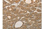 The image on the left is immunohistochemistry of paraffin-embedded Human thyroid cancer tissue using CSB-PA985349(AKR1C1 Antibody) at dilution 1/20, on the right is treated with synthetic peptide. (Original magnification: 