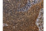 The image on the left is immunohistochemistry of paraffin-embedded Human cervical cancer tissue using CSB-PA985521(FHL3 Antibody) at dilution 1/40, on the right is treated with fusion protein. (Original magnification: 