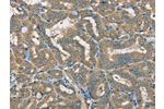 The image on the left is immunohistochemistry of paraffin-embedded Human thyroid cancer tissue using CSB-PA985822(ATP2A3 Antibody) at dilution 1/30, on the right is treated with synthetic peptide. (Original magnification: 