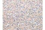 The image on the left is immunohistochemistry of paraffin-embedded Human liver cancer tissue using CSB-PA985994(CHRM5 Antibody) at dilution 1/20, on the right is treated with synthetic peptide. (Original magnification: 