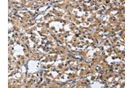 The image on the left is immunohistochemistry of paraffin-embedded Human thyroid cancer tissue using CSB-PA986354(CDK5RAP3 Antibody) at dilution 1/40, on the right is treated with fusion protein. (Original magnification: 