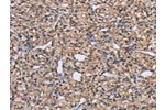 The image on the left is immunohistochemistry of paraffin-embedded Human prostate cancer tissue using CSB-PA986639(ADAM29 Antibody) at dilution 1/40, on the right is treated with synthetic peptide. (Original magnification: 