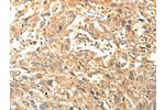 The image on the left is immunohistochemistry of paraffin-embedded Human esophagus cancer tissue using CSB-PA986930(AGRN Antibody) at dilution 1/30, on the right is treated with synthetic peptide. (Original magnification: 