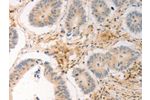 The image on the left is immunohistochemistry of paraffin-embedded Human colon cancer tissue using CSB-PA987235(AVPR2 Antibody) at dilution 1/30, on the right is treated with synthetic peptide. (Original magnification: 