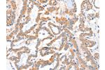 The image on the left is immunohistochemistry of paraffin-embedded Human thyroid cancer tissue using CSB-PA988330(ACSBG1 Antibody) at dilution 1/40, on the right is treated with fusion protein. (Original magnification: 