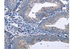 The image on the left is immunohistochemistry of paraffin-embedded Human cervical cancer tissue using CSB-PA988388(BDNF Antibody) at dilution 1/40, on the right is treated with synthetic peptide. (Original magnification: 