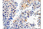 The image on the left is immunohistochemistry of paraffin-embedded Human liver cancer tissue using CSB-PA988836(ABCG2 Antibody) at dilution 1/100, on the right is treated with synthetic peptide. (Original magnification: 