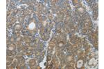 The image on the left is immunohistochemistry of paraffin-embedded Human thyroid cancer tissue using CSB-PA989223(CXCR3 Antibody) at dilution 1/20, on the right is treated with fusion protein. (Original magnification: 