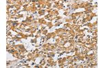 The image on the left is immunohistochemistry of paraffin-embedded Human thyroid cancer tissue using CSB-PA990163(ARHGAP15 Antibody) at dilution 1/50, on the right is treated with fusion protein. (Original magnification: 