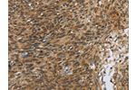 The image on the left is immunohistochemistry of paraffin-embedded Human cervical cancer tissue using CSB-PA990722(FOXB1 Antibody) at dilution 1/30, on the right is treated with synthetic peptide. (Original magnification: 