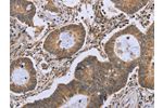 The image on the left is immunohistochemistry of paraffin-embedded Human colon cancer tissue using CSB-PA990771(FKBP8 Antibody) at dilution 1/50, on the right is treated with fusion protein. (Original magnification: 