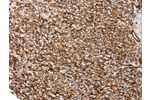 The image on the left is immunohistochemistry of paraffin-embedded Human prostate cancer tissue using CSB-PA990867(AQP1 Antibody) at dilution 1/20, on the right is treated with synthetic peptide. (Original magnification: 