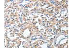The image on the left is immunohistochemistry of paraffin-embedded Human thyroid cancer tissue using CSB-PA990883(CGB Antibody) at dilution 1/40, on the right is treated with fusion protein. (Original magnification: 