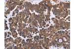 The image on the left is immunohistochemistry of paraffin-embedded Human ovarian cancer tissue using CSB-PA991151(CA4 Antibody) at dilution 1/30, on the right is treated with fusion protein. (Original magnification: 