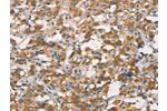 The image on the left is immunohistochemistry of paraffin-embedded Human thyroid cancer tissue using CSB-PA991727(FZD1 Antibody) at dilution 1/15, on the right is treated with synthetic peptide. (Original magnification: 