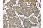 The image on the left is immunohistochemistry of paraffin-embedded Human breast cancer tissue using CSB-PA992010(EIF5 Antibody) at dilution 1/25, on the right is treated with fusion protein. (Original magnification: 