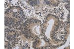 The image on the left is immunohistochemistry of paraffin-embedded Human colon cancer tissue using CSB-PA992612(ALX4 Antibody) at dilution 1/20, on the right is treated with synthetic peptide. (Original magnification: 