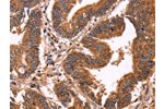 The image on the left is immunohistochemistry of paraffin-embedded Human colon cancer tissue using CSB-PA992687(ERP29 Antibody) at dilution 1/40, on the right is treated with synthetic peptide. (Original magnification: 