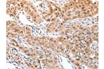 The image on the left is immunohistochemistry of paraffin-embedded Human lung cancer tissue using CSB-PA992708(DPPA2 Antibody) at dilution 1/30, on the right is treated with fusion protein. (Original magnification: 