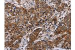 The image on the left is immunohistochemistry of paraffin-embedded Human liver cancer tissue using CSB-PA993404(FAF1 Antibody) at dilution 1/50, on the right is treated with synthetic peptide. (Original magnification: 