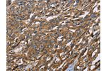 The image on the left is immunohistochemistry of paraffin-embedded Human esophagus cancer tissue using CSB-PA993569(BSG Antibody) at dilution 1/60, on the right is treated with fusion protein. (Original magnification: 