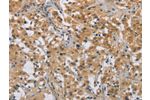 The image on the left is immunohistochemistry of paraffin-embedded Human thyroid cancer tissue using CSB-PA994119(DDX43 Antibody) at dilution 1/50, on the right is treated with fusion protein. (Original magnification: 
