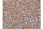 The image on the left is immunohistochemistry of paraffin-embedded Human prostate cancer tissue using CSB-PA994398(ENPP7 Antibody) at dilution 1/40, on the right is treated with synthetic peptide. (Original magnification: 
