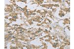 The image on the left is immunohistochemistry of paraffin-embedded Human thyroid cancer tissue using CSB-PA994433(EEF2 Antibody) at dilution 1/20, on the right is treated with fusion protein. (Original magnification: 