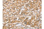 The image on the left is immunohistochemistry of paraffin-embedded Human thyroid cancer tissue using CSB-PA994626(ARL8A Antibody) at dilution 1/20, on the right is treated with fusion protein. (Original magnification: 