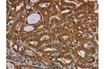 The image on the left is immunohistochemistry of paraffin-embedded Human thyroid cancer tissue using CSB-PA994661(CENPU Antibody) at dilution 1/30, on the right is treated with fusion protein. (Original magnification: 